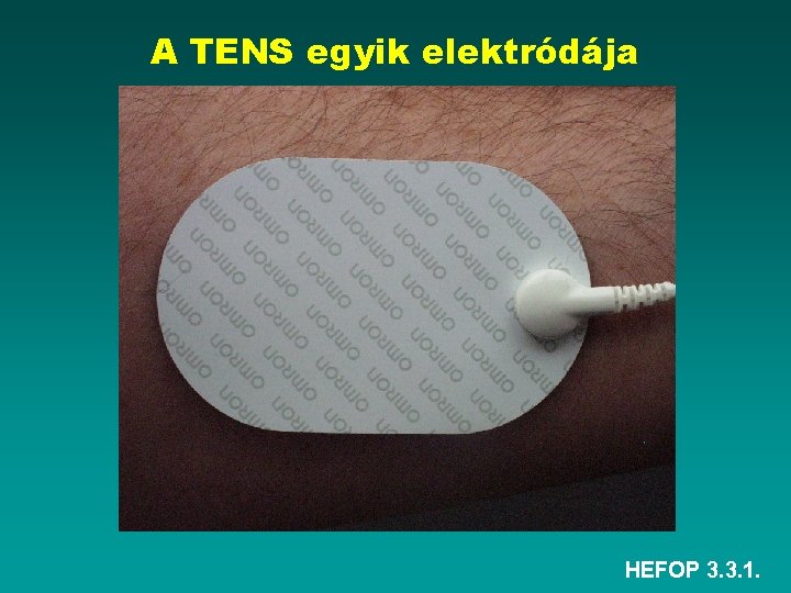 A TENS egyik elektródája HEFOP 3. 3. 1. 