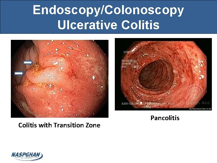 Endoscopy/Colonoscopy Ulcerative Colitis with Transition Zone Pancolitis 