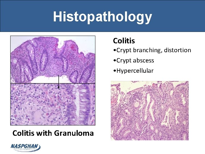 Histopathology Colitis • Crypt branching, distortion • Crypt abscess • Hypercellular Colitis with Granuloma