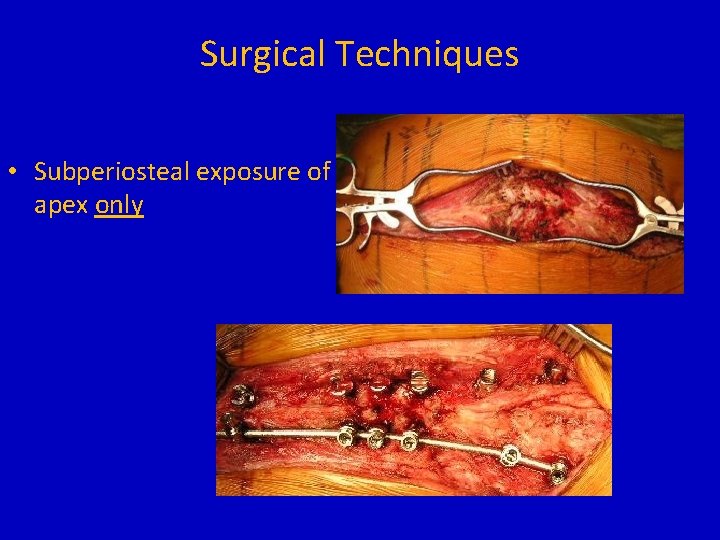 Surgical Techniques • Subperiosteal exposure of apex only 