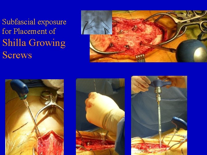 Subfascial exposure for Placement of Shilla Growing Screws 