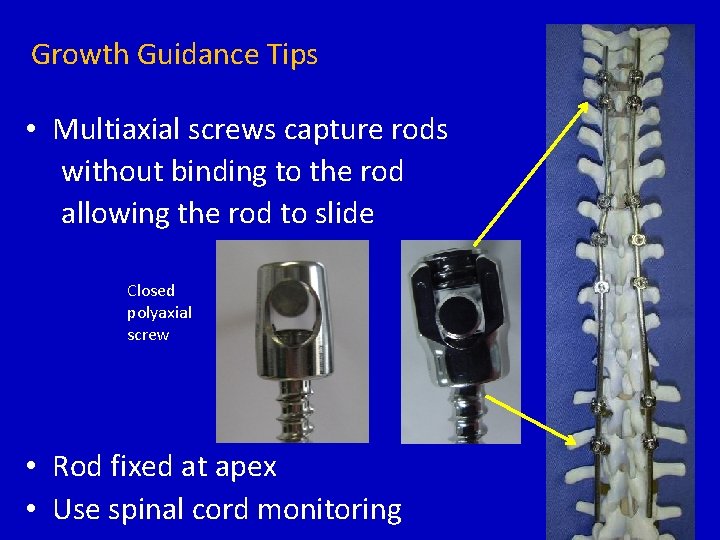 Growth Guidance Tips • Multiaxial screws capture rods without binding to the rod allowing