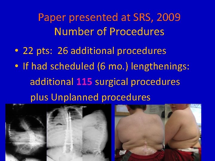 Paper presented at SRS, 2009 Number of Procedures • 22 pts: 26 additional procedures