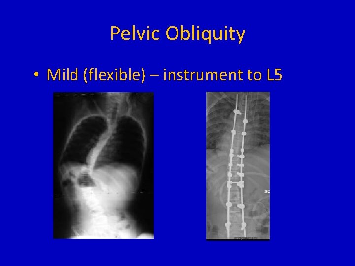 Pelvic Obliquity • Mild (flexible) – instrument to L 5 