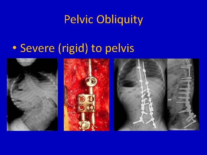 Pelvic Obliquity • Severe (rigid) to pelvis 