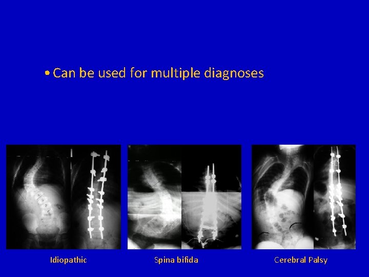  • Can be used for multiple diagnoses Idiopathic Spina bifida Cerebral Palsy 