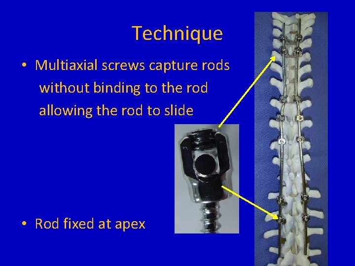 Technique • Multiaxial screws capture rods without binding to the rod allowing the rod