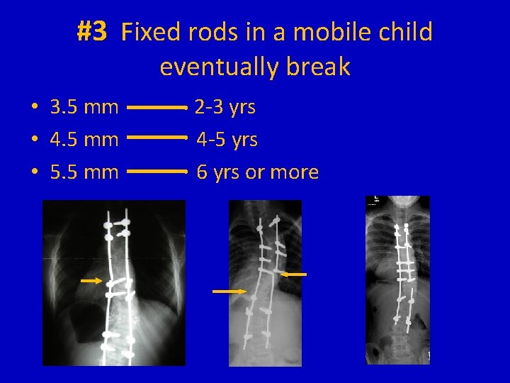 #3 Fixed rods in a mobile child eventually break • 3. 5 mm •