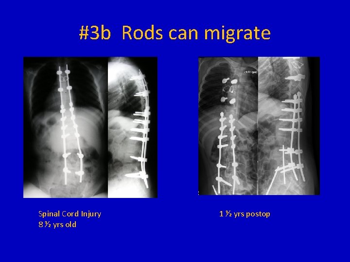 #3 b Rods can migrate Spinal Cord Injury 8 ½ yrs old 1 ½
