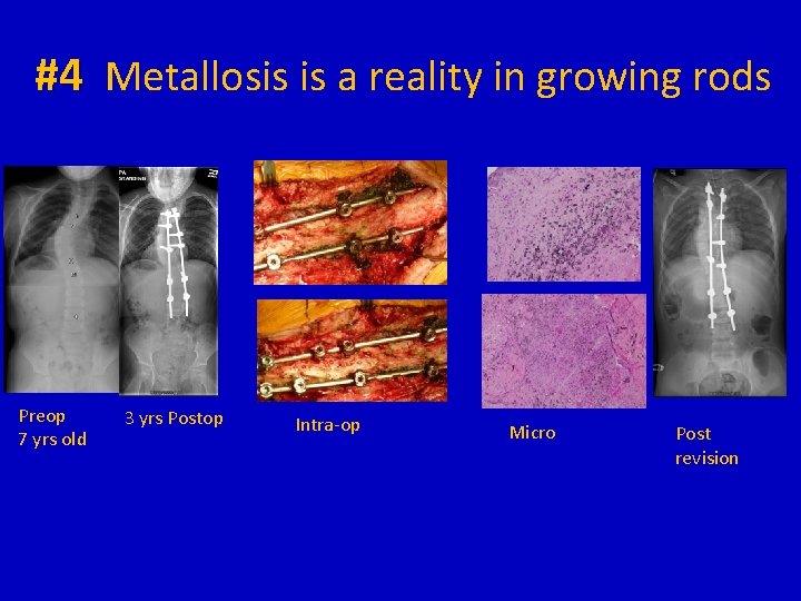 #4 Metallosis is a reality in growing rods Preop 7 yrs old 3 yrs