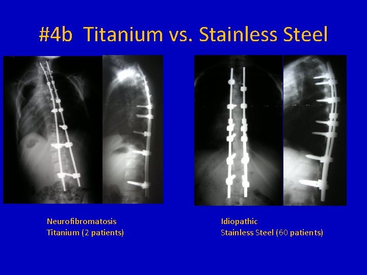 #4 b Titanium vs. Stainless Steel Neurofibromatosis Titanium (2 patients) Idiopathic Stainless Steel (60