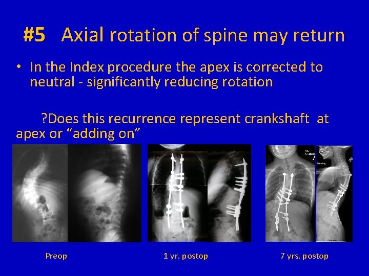 #5 Axial rotation of spine may return • In the Index procedure the apex