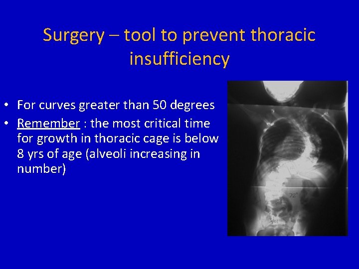 Surgery – tool to prevent thoracic insufficiency • For curves greater than 50 degrees