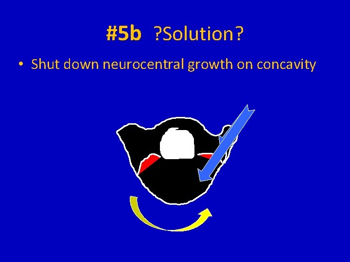 #5 b ? Solution? • Shut down neurocentral growth on concavity 