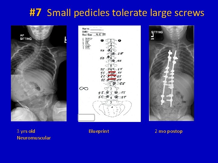 #7 Small pedicles tolerate large screws 3 yrs old Neuromuscular Blueprint 2 mo postop