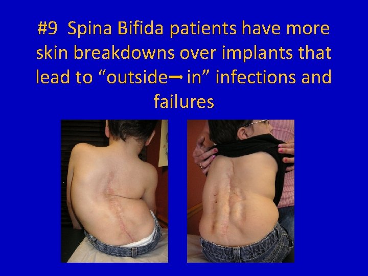 #9 Spina Bifida patients have more skin breakdowns over implants that lead to “outside
