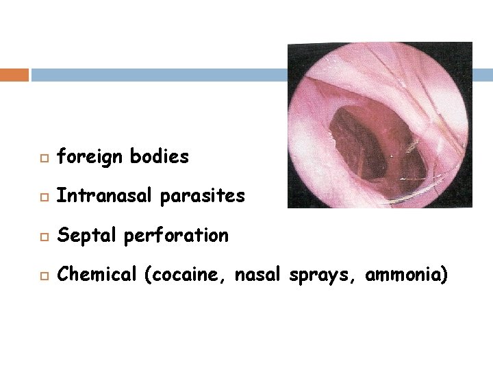  foreign bodies Intranasal parasites Septal perforation Chemical (cocaine, nasal sprays, ammonia) 