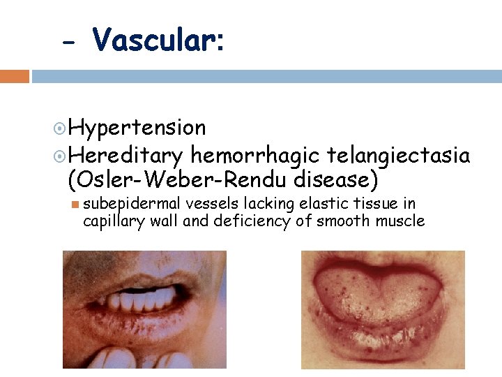 - Vascular: Hypertension Hereditary hemorrhagic telangiectasia (Osler-Weber-Rendu disease) subepidermal vessels lacking elastic tissue in