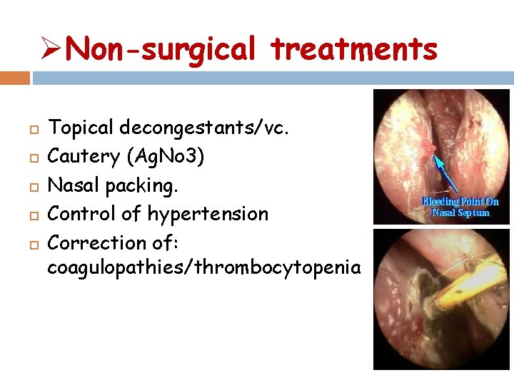 ØNon-surgical treatments Topical decongestants/vc. Cautery (Ag. No 3) Nasal packing. Control of hypertension Correction