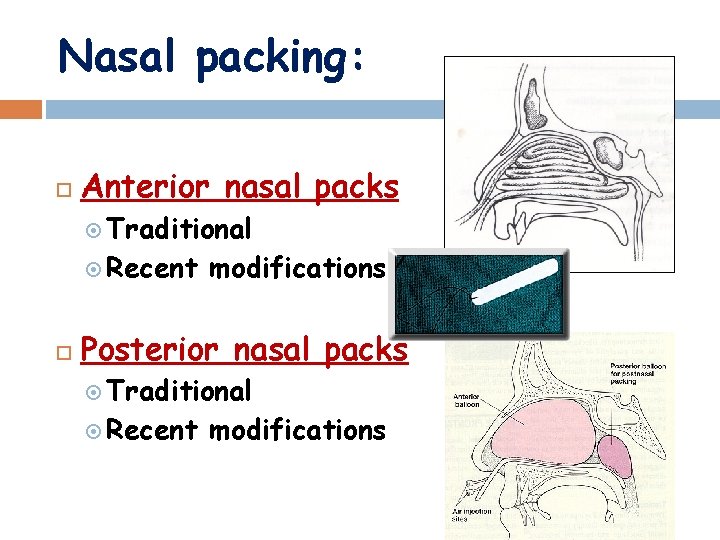 Nasal packing: Anterior nasal packs Traditional Recent modifications Posterior nasal packs Traditional Recent modifications