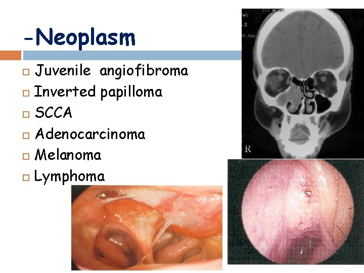 -Neoplasm Juvenile angiofibroma Inverted papilloma SCCA Adenocarcinoma Melanoma Lymphoma 