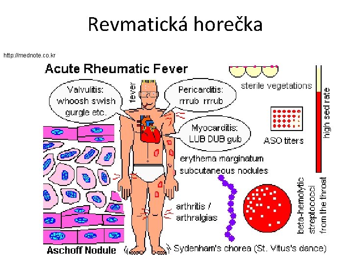 Revmatická horečka http: //mednote. co. kr 