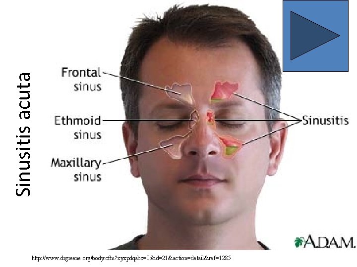 Sinusitis acuta http: //www. drgreene. org/body. cfm? xyzpdqabc=0&id=21&action=detail&ref=1285 