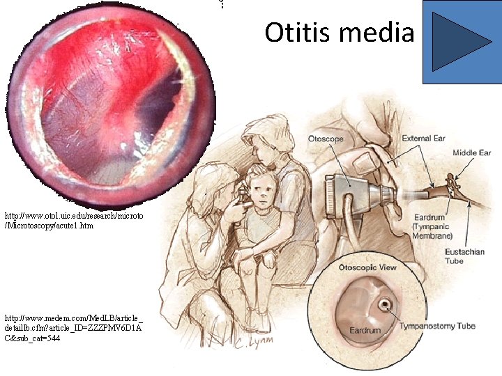 Otitis media http: //www. otol. uic. edu/research/microto /Microtoscopy/acute 1. htm http: //www. medem. com/Med.