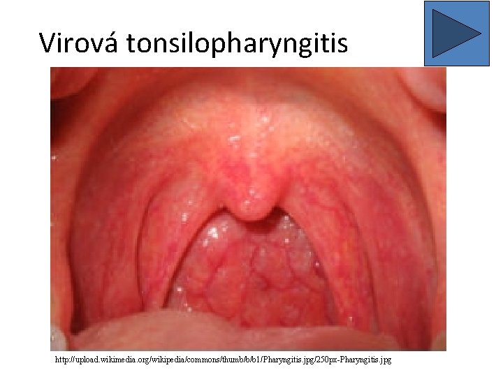 Virová tonsilopharyngitis http: //upload. wikimedia. org/wikipedia/commons/thumb/b/b 1/Pharyngitis. jpg/250 px-Pharyngitis. jpg 