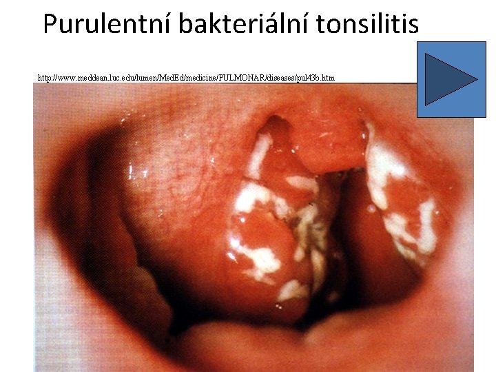 Purulentní bakteriální tonsilitis http: //www. meddean. luc. edu/lumen/Med. Ed/medicine/PULMONAR/diseases/pul 43 b. htm 