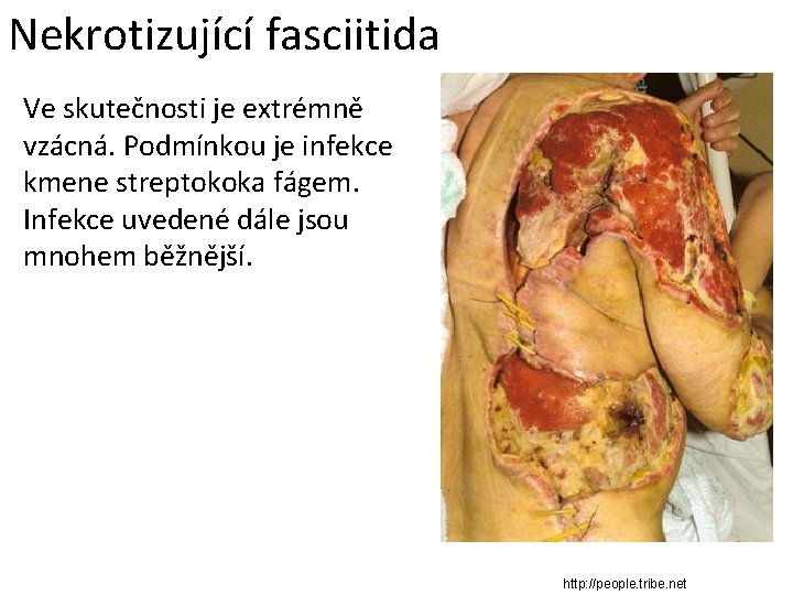 Nekrotizující fasciitida Ve skutečnosti je extrémně vzácná. Podmínkou je infekce kmene streptokoka fágem. Infekce