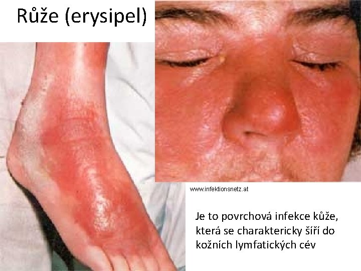 Růže (erysipel) www. infektionsnetz. at Je to povrchová infekce kůže, která se charaktericky šíří