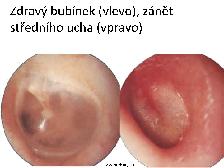 Zdravý bubínek (vlevo), zánět středního ucha (vpravo) www. pedisurg. com 