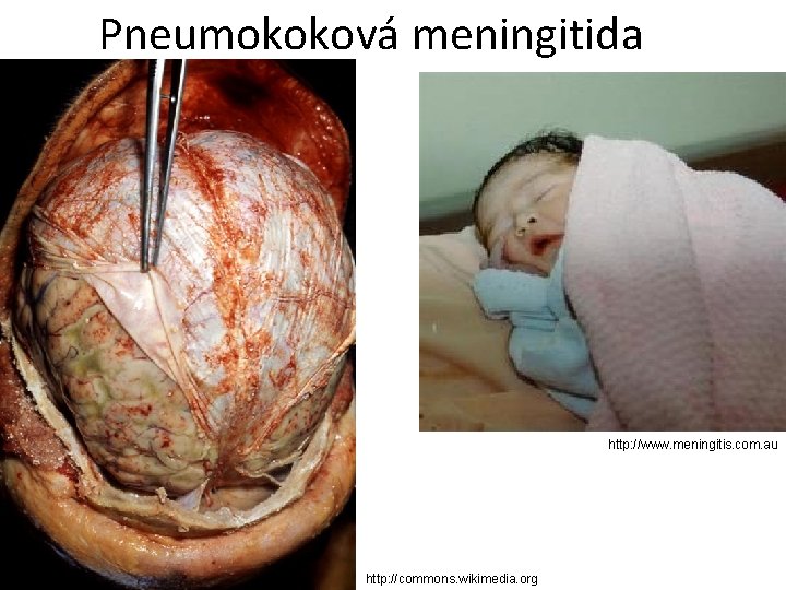 Pneumokoková meningitida http: //www. meningitis. com. au http: //commons. wikimedia. org 