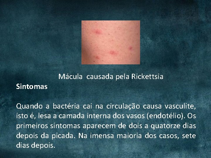 Sintomas Mácula causada pela Rickettsia Quando a bactéria cai na circulação causa vasculite, isto Sintomas Mácula causada pela Rickettsia Quando a bactéria cai na circulação causa vasculite, isto