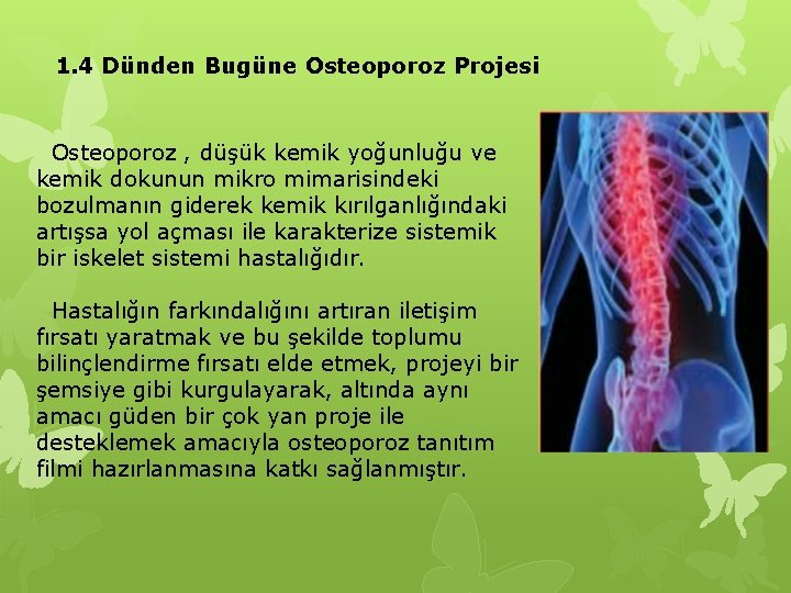 1. 4 Dünden Bugüne Osteoporoz Projesi Osteoporoz , düşük kemik yoğunluğu ve kemik dokunun