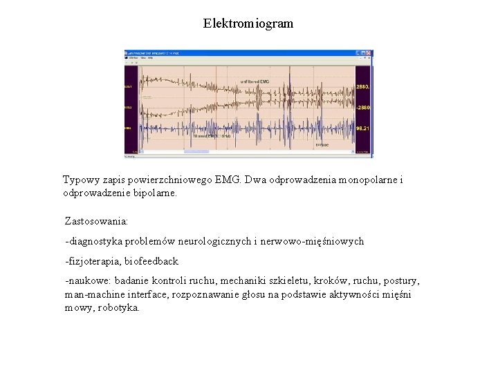 Elektromiogram Typowy zapis powierzchniowego EMG. Dwa odprowadzenia monopolarne i odprowadzenie bipolarne. Zastosowania: -diagnostyka problemów