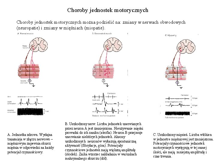 Choroby jednostek motorycznych można podzielić na: zmiany w nerwach obwodowych (neuropatie) i zmiany w
