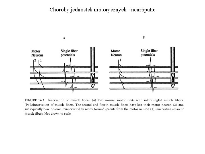 Choroby jednostek motorycznych - neuropatie 