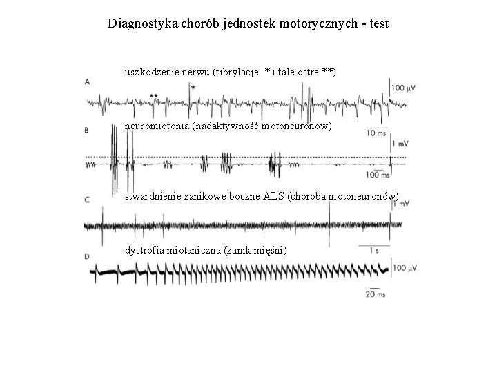 Diagnostyka chorób jednostek motorycznych - test uszkodzenie nerwu (fibrylacje * i fale ostre **)