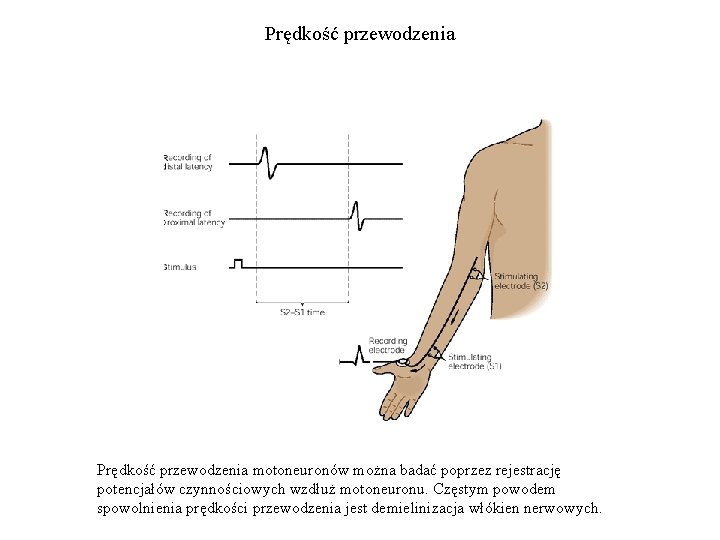 Prędkość przewodzenia motoneuronów można badać poprzez rejestrację potencjałów czynnościowych wzdłuż motoneuronu. Częstym powodem spowolnienia