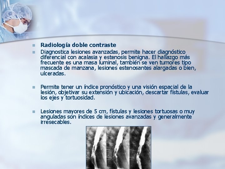 n n Radiología doble contraste Diagnostica lesiones avanzadas, permite hacer diagnóstico diferencial con acalasia