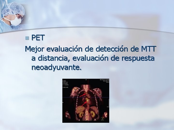 PET Mejor evaluación de detección de MTT a distancia, evaluación de respuesta neoadyuvante. n