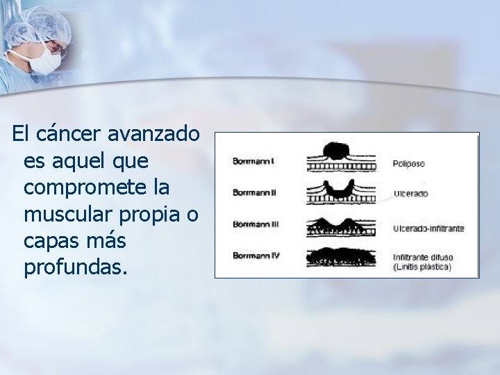 El cáncer avanzado es aquel que compromete la muscular propia o capas más profundas.