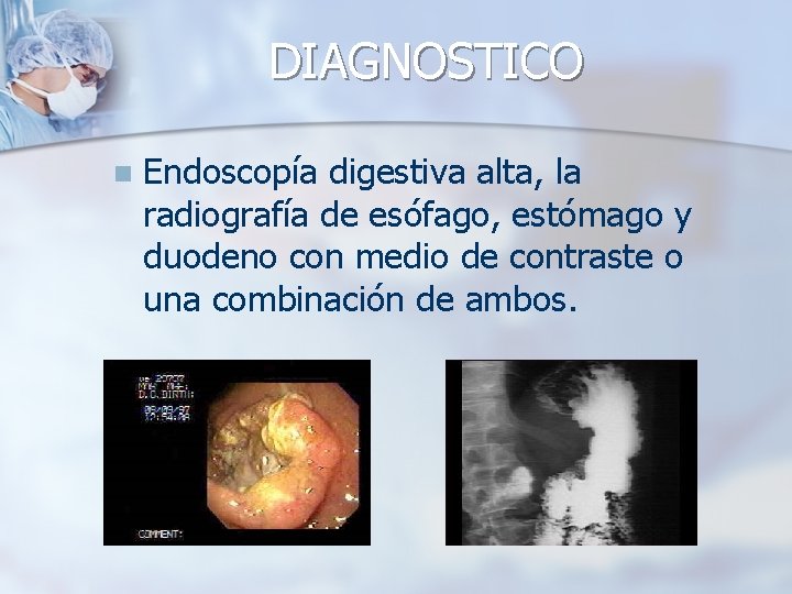 DIAGNOSTICO n Endoscopía digestiva alta, la radiografía de esófago, estómago y duodeno con medio