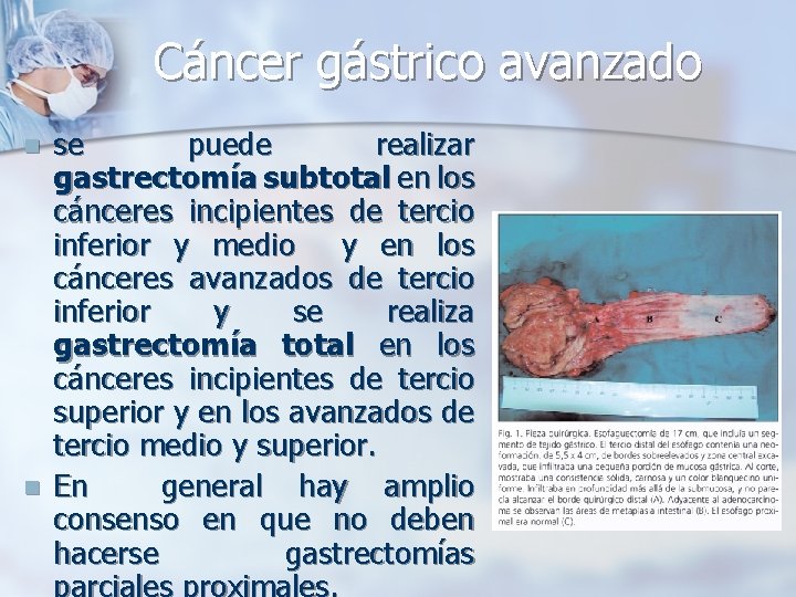 Cáncer gástrico avanzado n n se puede realizar gastrectomía subtotal en los cánceres incipientes