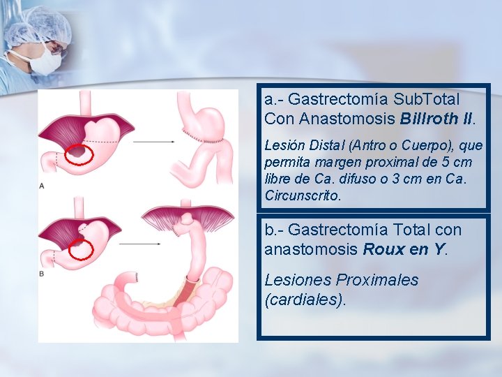 a. - Gastrectomía Sub. Total Con Anastomosis Billroth II. Lesión Distal (Antro o Cuerpo),