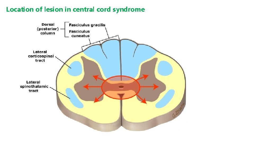 Location of lesion in central cord syndrome 