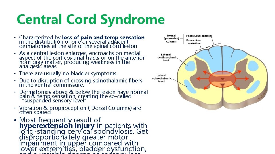 Central Cord Syndrome • Characterized by loss of pain and temp sensation in the