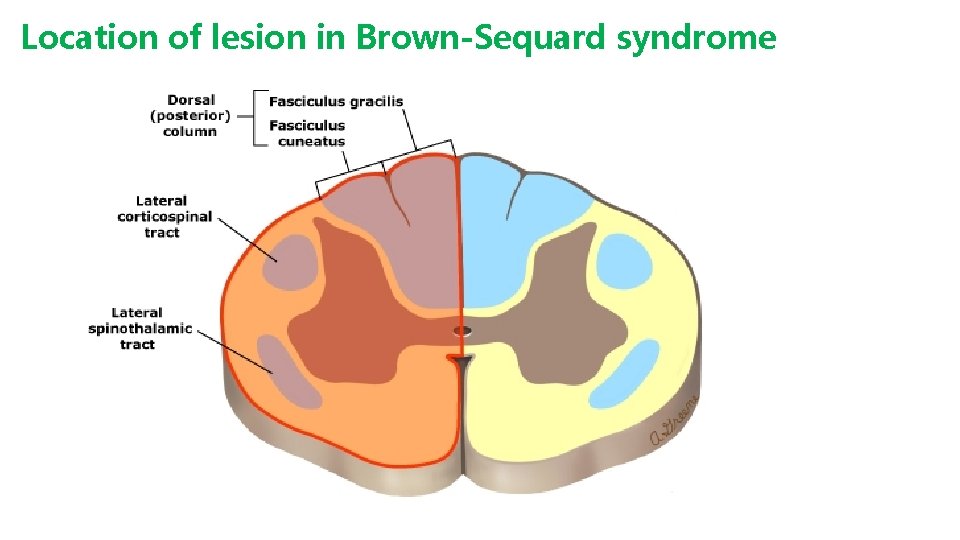 Location of lesion in Brown-Sequard syndrome 